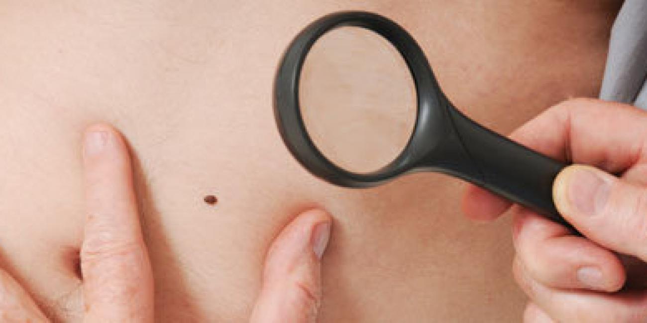 Coronavirus : des rougeurs sur la peau peuvent être un signe de la ...